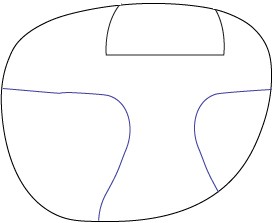 Chadwick's Freeform progressive with standard flat-top bifocal
