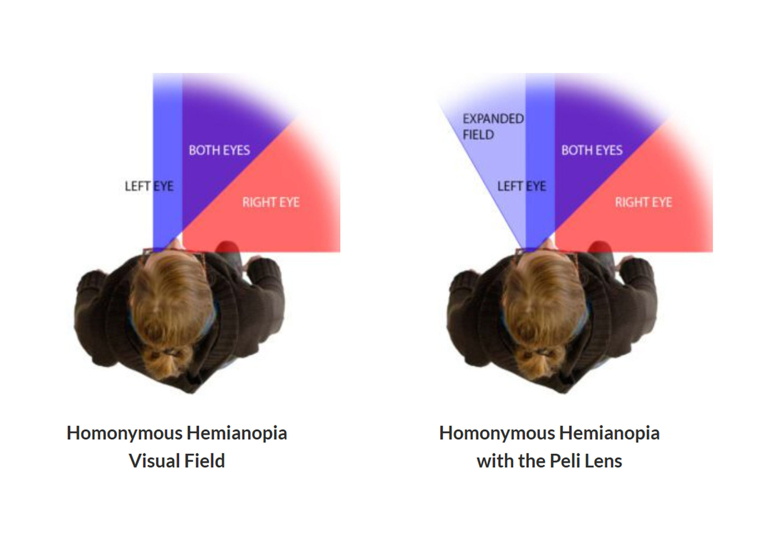 homonymous-hemianopia-peli-lens